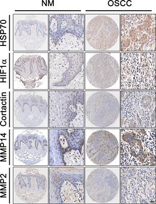 Heat Shock Proteins 70 Regulate Cell Motility and Invadopodia-Associated Proteins Expression in Oral Squamous Cell Carcinoma